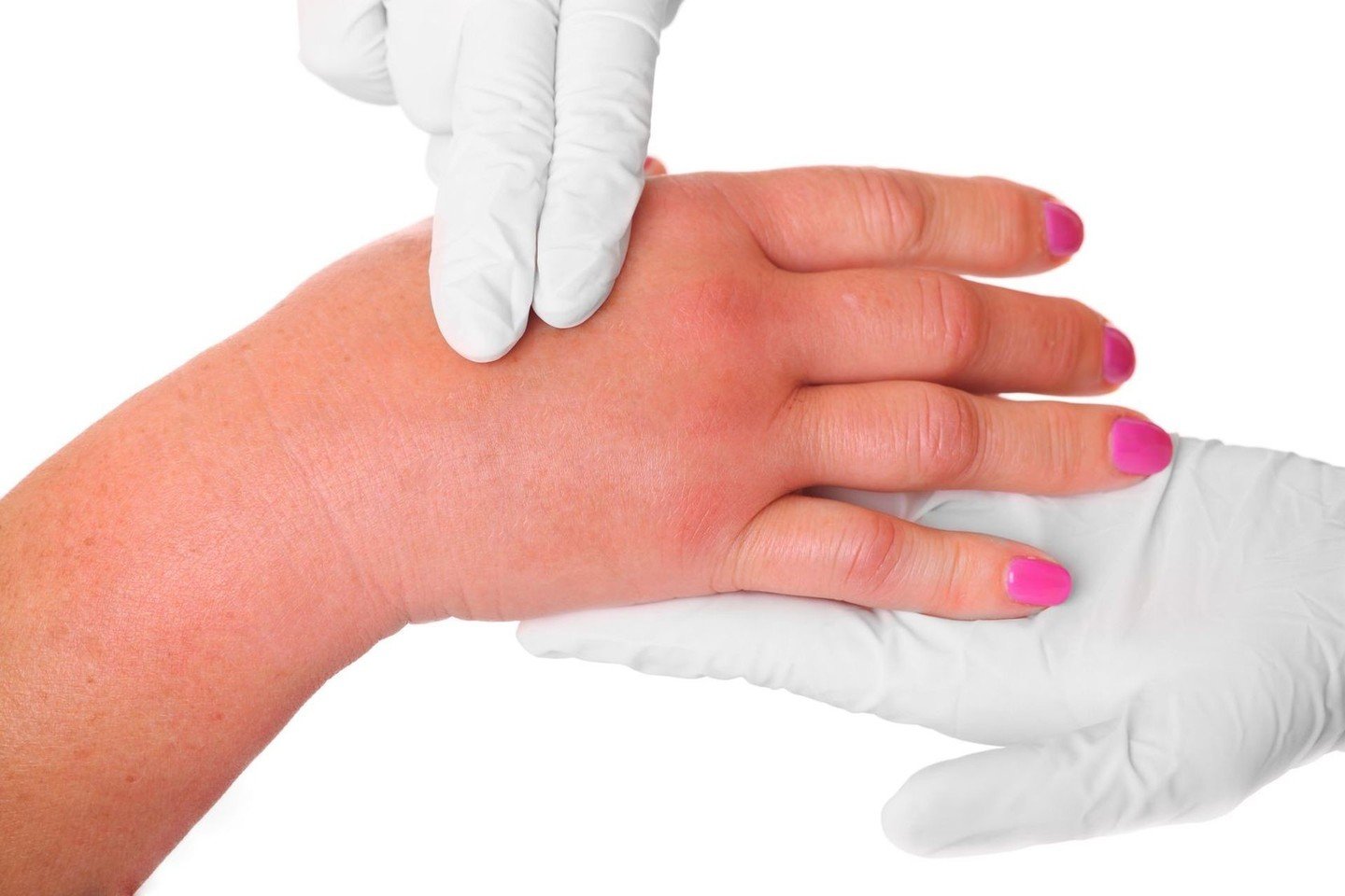 skausmas pirštų pagalvėlės rankų rusiski vaistai nuo sanariu skausmo