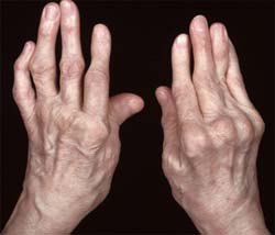 artritas peties išlaikyti liaudies gydymas