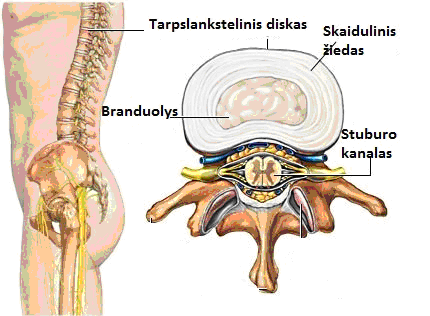 osteochondrozė pagal mentele gydymas liaudies gynimo rotatorių manžetės sindromas