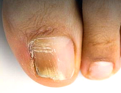 artritas pirštai šepetys crack ir sąnarių skausmas