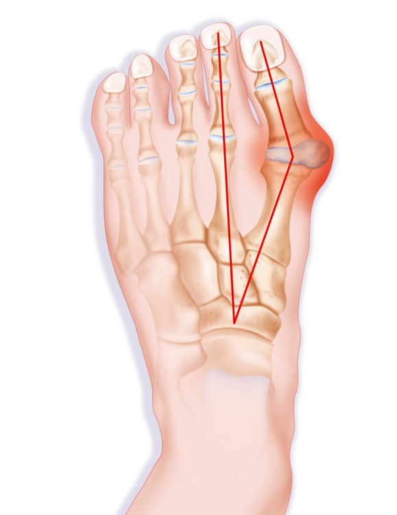 kojos nykscio skausmas skauda kairėje alkūnės sąnario ką daryti