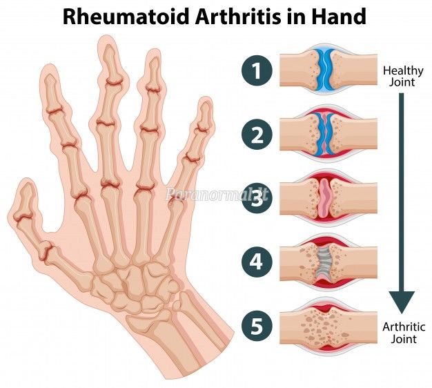 reumatoidinis artritas artrito gydymui liaudies metodų kaulų tepalas nuo sąnarių