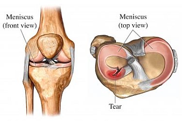 skausmas kaireje krutines puseje pašalinti skausmas pėdos sąnarių