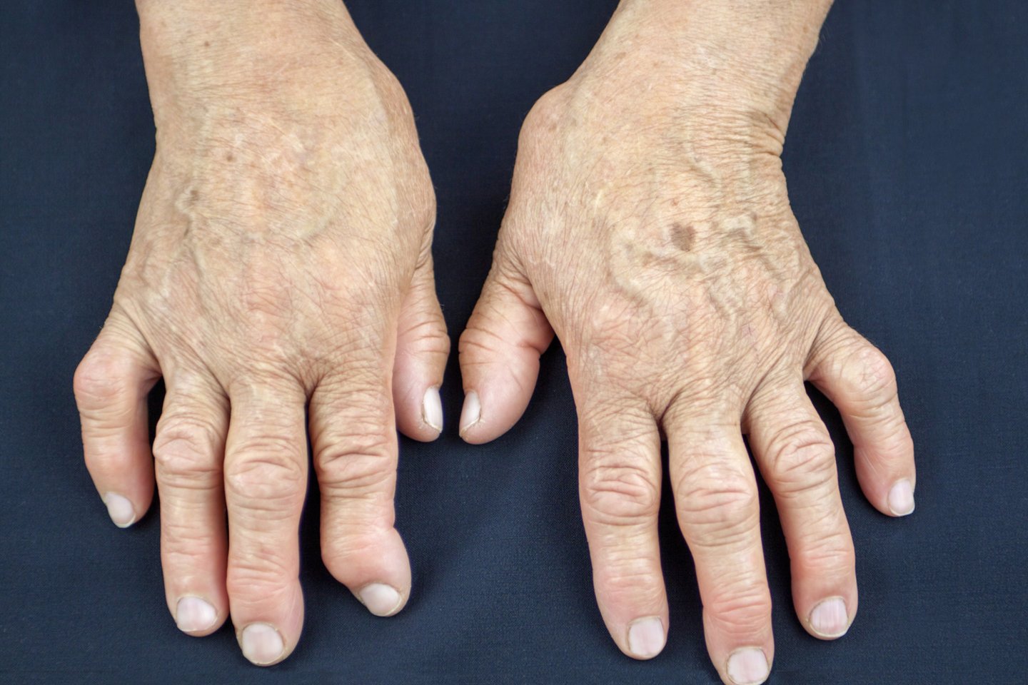 artritas yra sąnarių gydymas