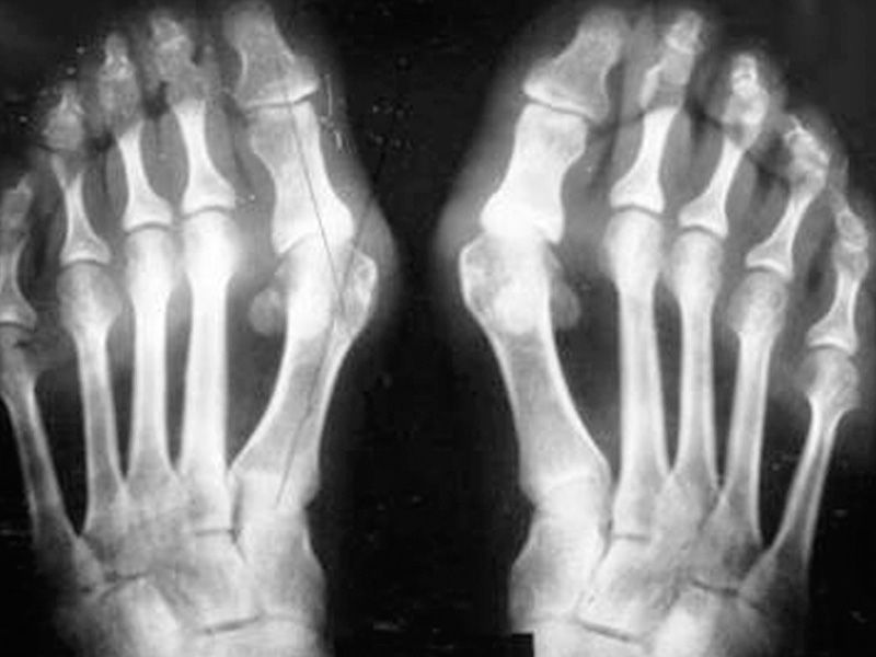 gogress artrozė pėdų gydymas peptidų gydymas sustav