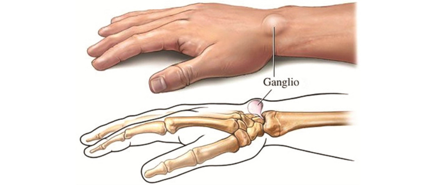 gerklės riešo sąnarių ant rankos ką daryti gydymas sąnarių kamčiatkos