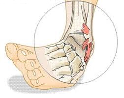 gydymas artrozės mažų pėdų sąnarių su raudonoji gerklės sąnarių