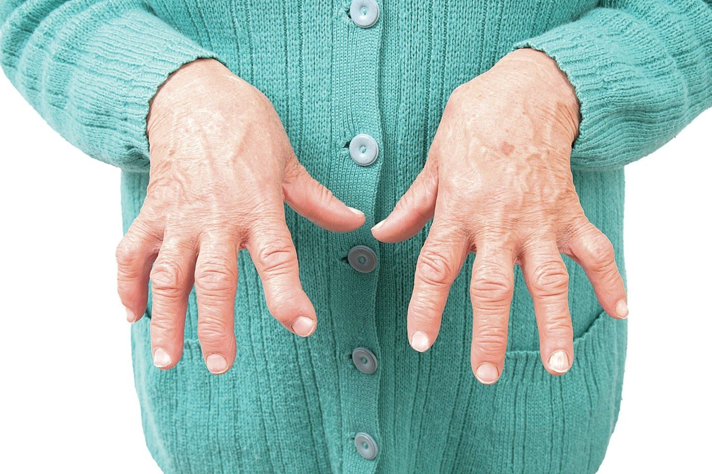 artritas ir artrozė brush rankų ir jo gydymas gydymas sąnarių metodu