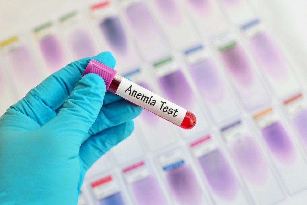 anemija ligų sąnarių gydymas artrozės ir tailbone liaudies gynimo priemones