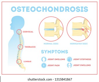 kremas d su osteochondroze kaip gydyti artritas artritas
