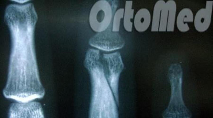 osteoartrito falanga bendra gydymas