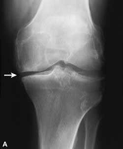 artritas kairiojo peties sąnario kas tai yra gydymas artrozės iš šepetėlio sąnarių