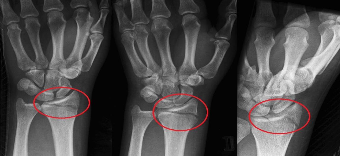 gydymas artrozė rankas namuose gerklės bendra iš kulniukai