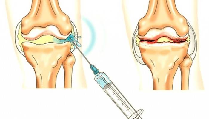 gydymas 1-ojo laipsnio osteoartrito prakaitavimas sąnarių skausmą