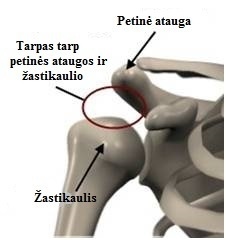 liaudies gynimo priemonės su osteoartritu sąnarių artritas rankų sąnarių