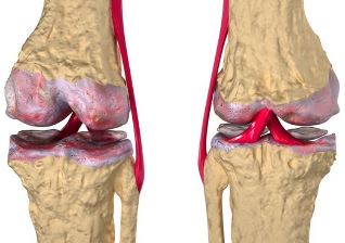 šiuolaikiniai įrenginiai osteoartrito gydymą po pamokų peties sąnario skauda