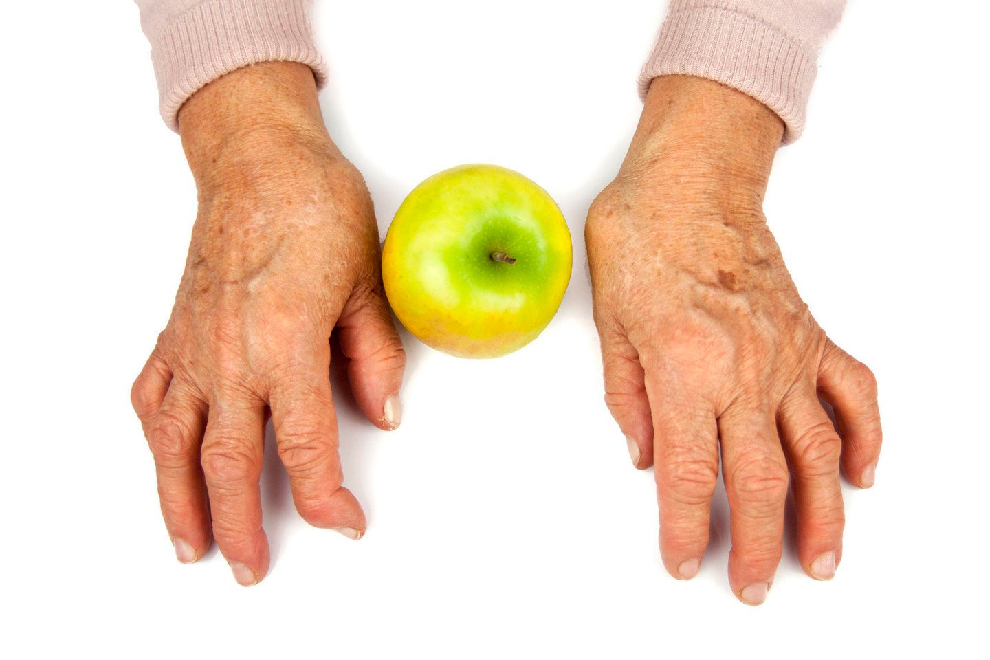 kas tepalas padeda su osteochondroze ūmaus artrito rankas