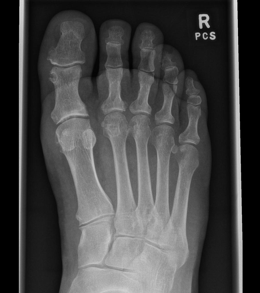 gout podagra x ray kas yra iš rankų sąnarių artritas