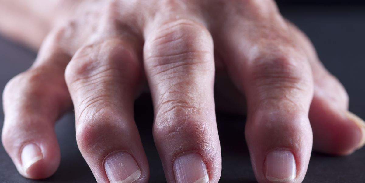 swelling in finger joints causes gydymas ekrano sąnarių