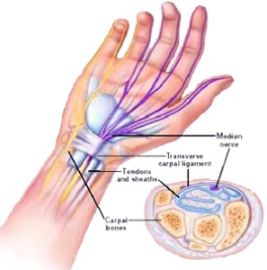 rankos plastakos skausmas reumatinės sąnarių skausmas gydymas