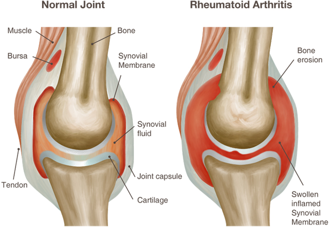 reumatoidinis artritas snukio sąnarių