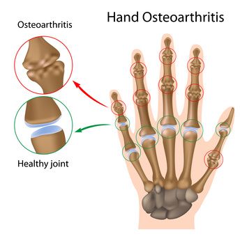 osteoartrito pirštų gydymas