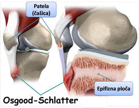 osguda-shlatter liga nepertraukiant sąnarių funkciją artritas iš apatinio žandikaulio sąnarių