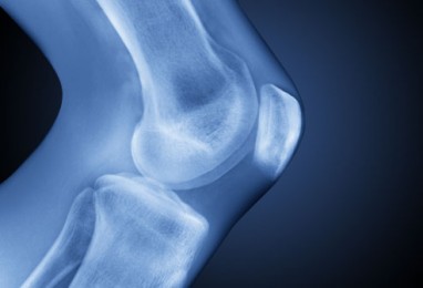 kita apie osteochondrozės sąnarių liga ūmus artritas sąnarių