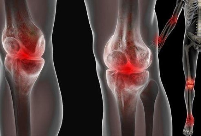 artritas ir artrozė sąnarių liaudies gynimo priemones skausmas nykščio kai vaikščioti sąnario