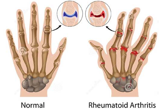 reumatoidinis artritas skystis pirštų sužalojimo sąnarių