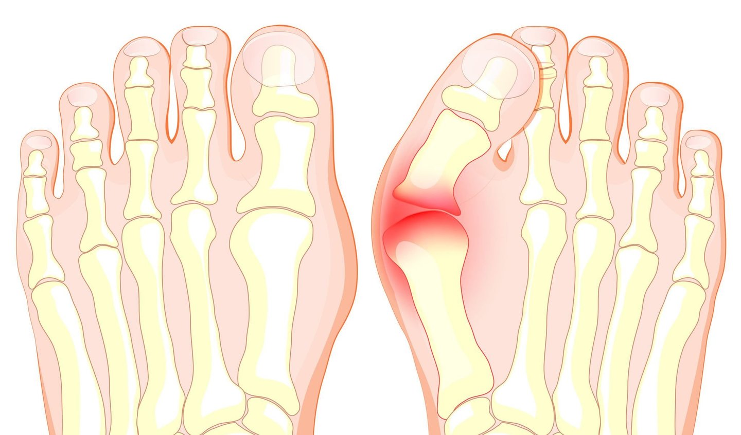 išnirimas pėdos gydymo sąnarių tepalas bendros osteochondrozės