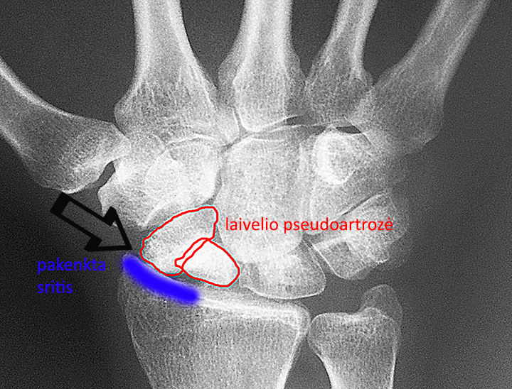 artrozė artritas rankos atsiliepimai kremas sąnarių mineralų altajaus