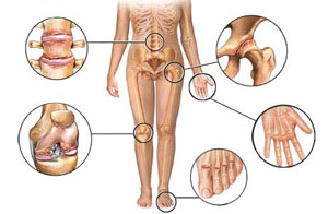 skaudančių sąnarių kairės rankos pirštų sąnarių osteoartritas