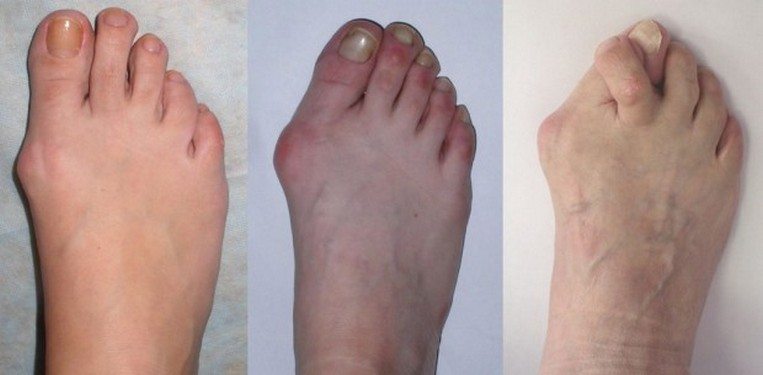 sąnarių pėdos kai vaikščioti radiologija iš sąnarių skausmas
