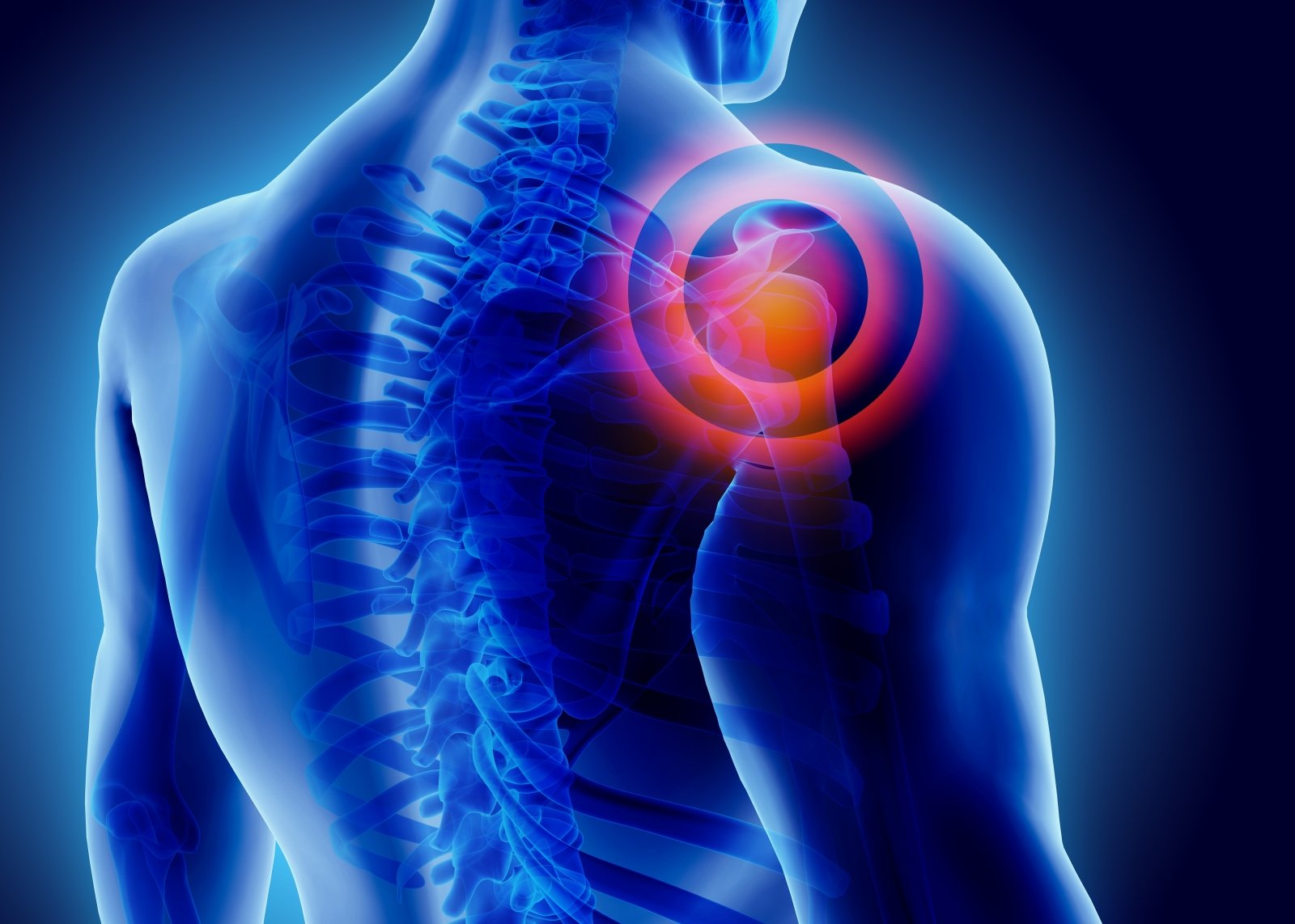 artrozė peties sustav tipai skausmas nugaros raumenų sąnarių