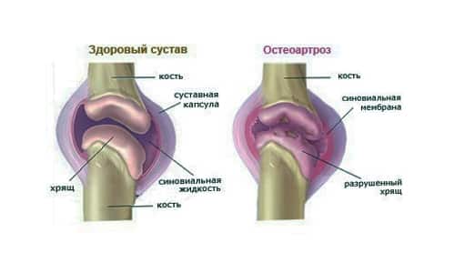 gydymas osteoartrito rankų atsiliepimus kur jie yra traktuojami sąnarių