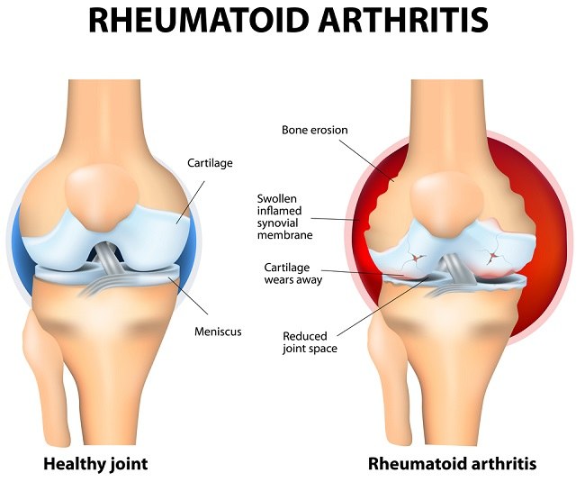 reumatoidinis artritas uždegimo gydymui sąnarių