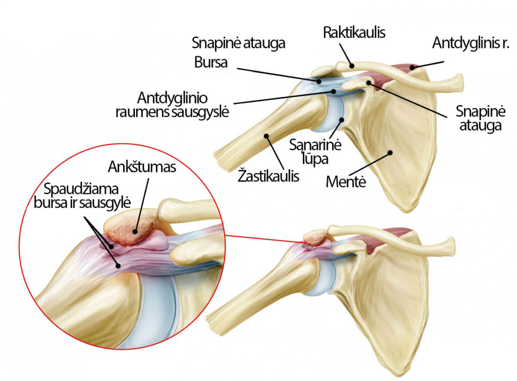artrozė peties sustav tipai artritas yra sąnarių artrito liaudies gynimo priemones