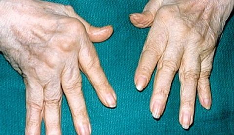 rankų sąnarių artrozės gydymas liaudies gynimo priemonėmis
