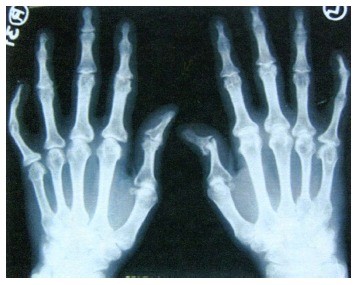artrozė artritas rankos artrozė ir poliartritas gydymas