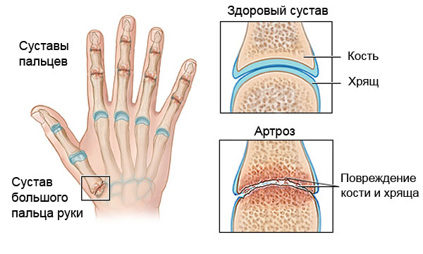 kaip nugalėti artrito rankų fitobalzes iš sąnarių skausmas