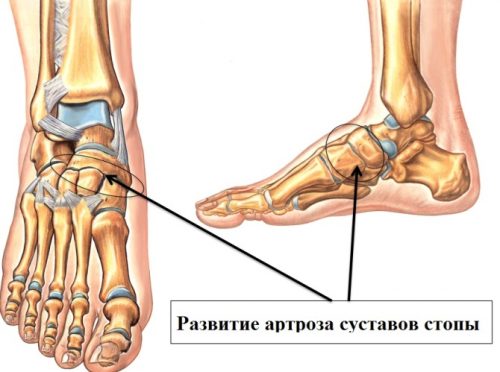 artrozė sustav 1 pėdų stabdyti skauda sąnarį nuo gydymo pirštu
