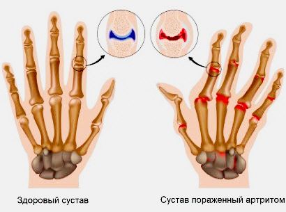 artritas rankų liaudies gynimo požymiai žasto sąnarių skausmas