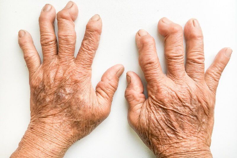 kaip gydyti artritą namuose