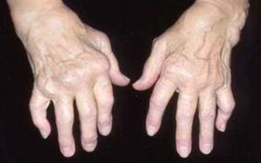 gydymo artritas šepečių rankos artritas ar artrozė pėdų gydymas