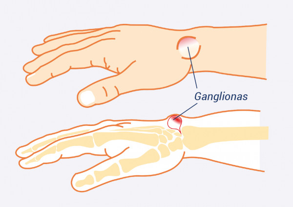 gerklės riešo sąnarių gydymas laikykite sąnarių rankas ryte