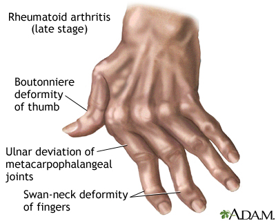 skausmas ir patinimas šepečių ir sustabdyti sąnarių mazi už arthris artrito gydymui