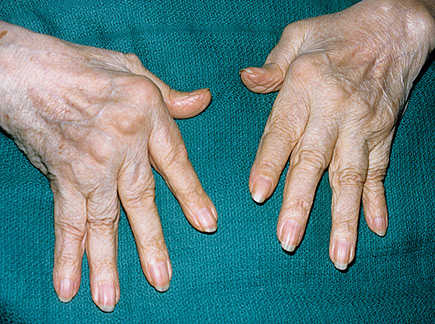 mazi už arthris artrito gydymui artrozė ligų gydymas namuose