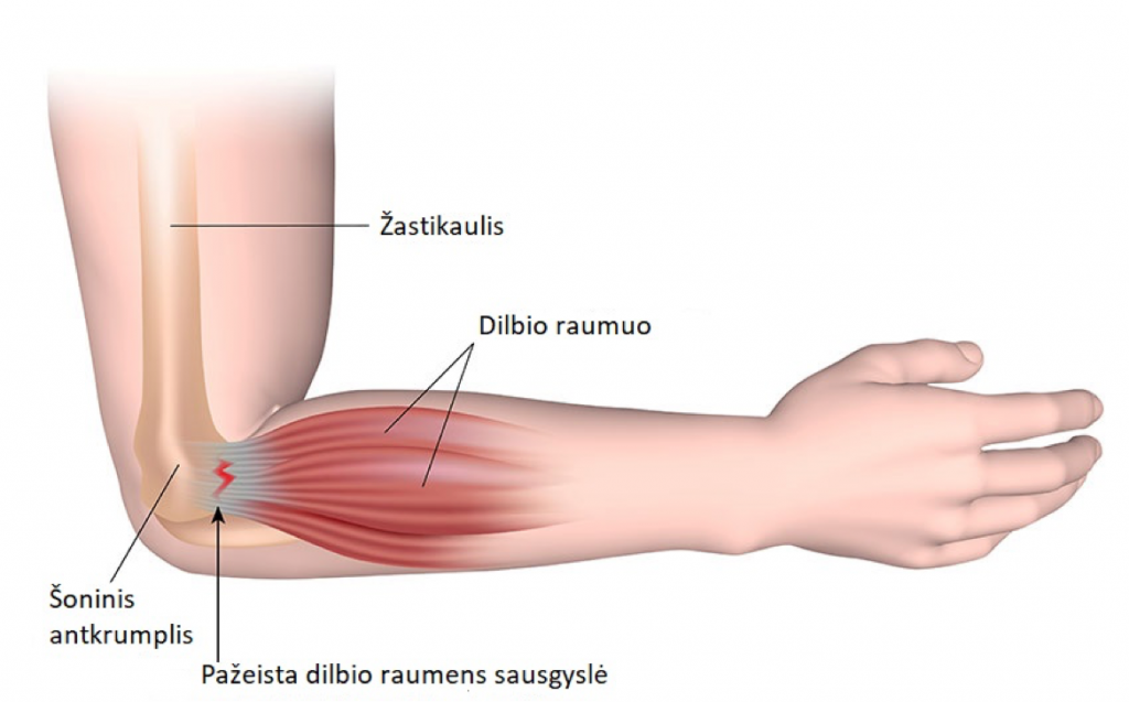 gydymas sąnarių traumos skausmas alkūnės sąnario kai lankstant į dešinę ranką
