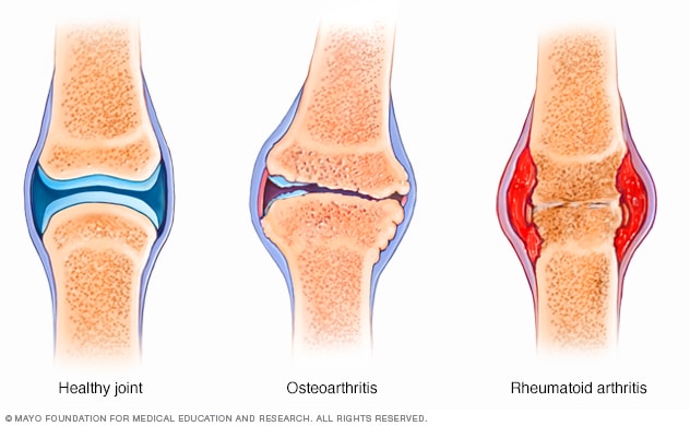 prevencija alkūnės sąnario osteoartrito tradiciniais metodais ir priemonėmis